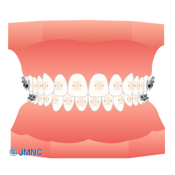 非金属ブラケット
