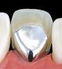 人工歯画像(奥歯)