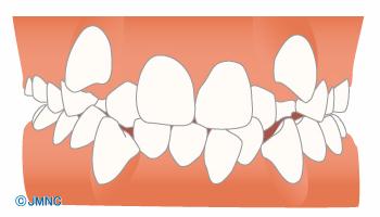 叢生(そうせい)