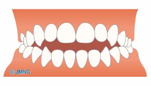 開咬(かいこう)