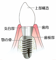 インプラント・イメージ