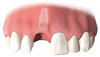 インプラントの埋入手術