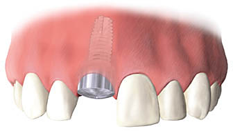 骨と結合させる